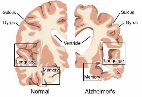 AD药物研发现状：辉瑞、礼来、百健、诺华、强生……