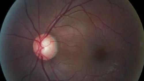 青光眼的克星来袭，助力患者远离视力的“窃贼”