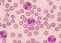 一种神秘颗粒被发现了！它能否成为败血症早筛标志物？